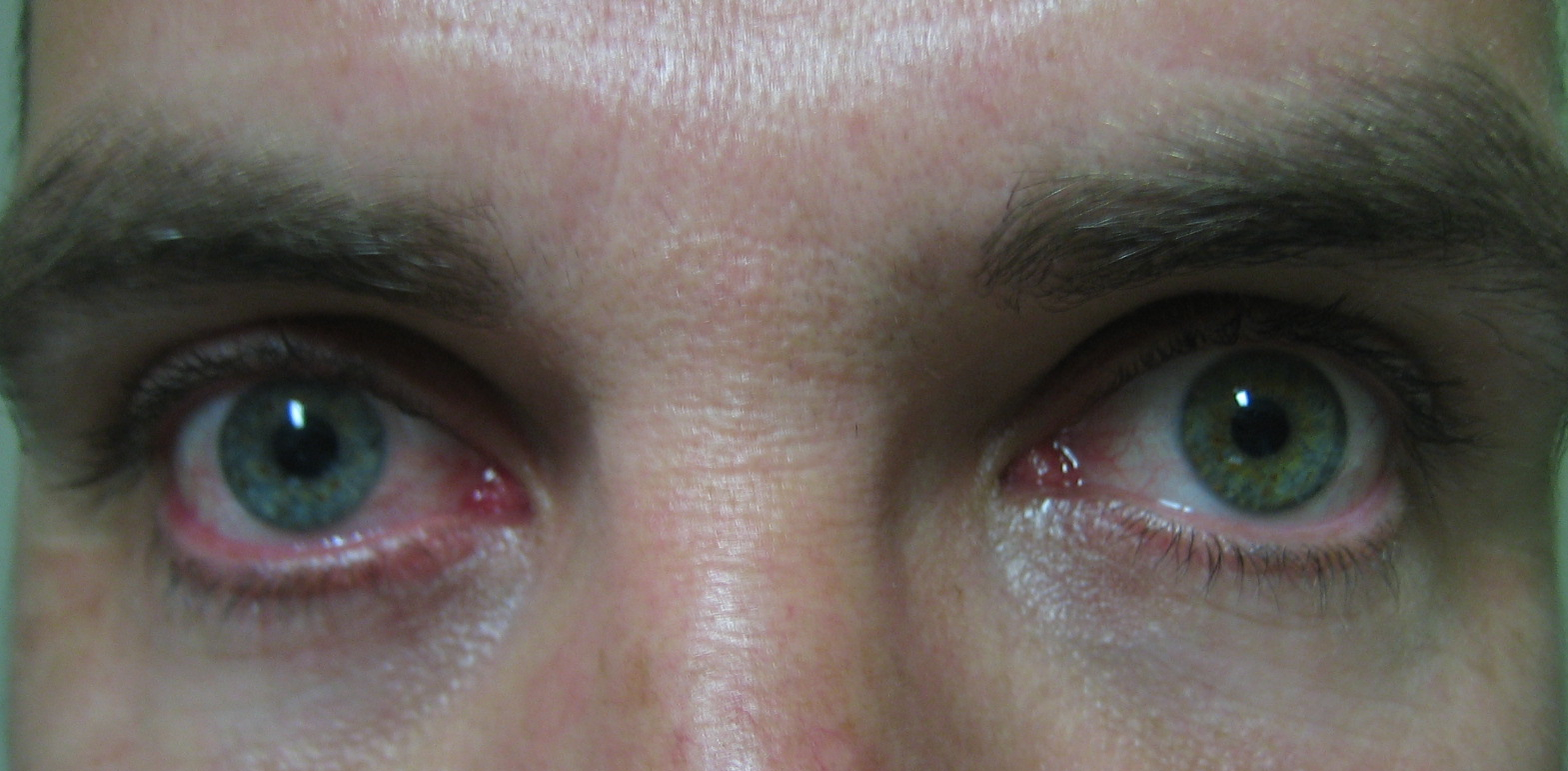 Figure 1.2.16 Fuchs Heterochromic Iridocyclitis
Heterochromia iridis is often the least prevalent sign in Fuchs Heterochromic Iridocyclitis