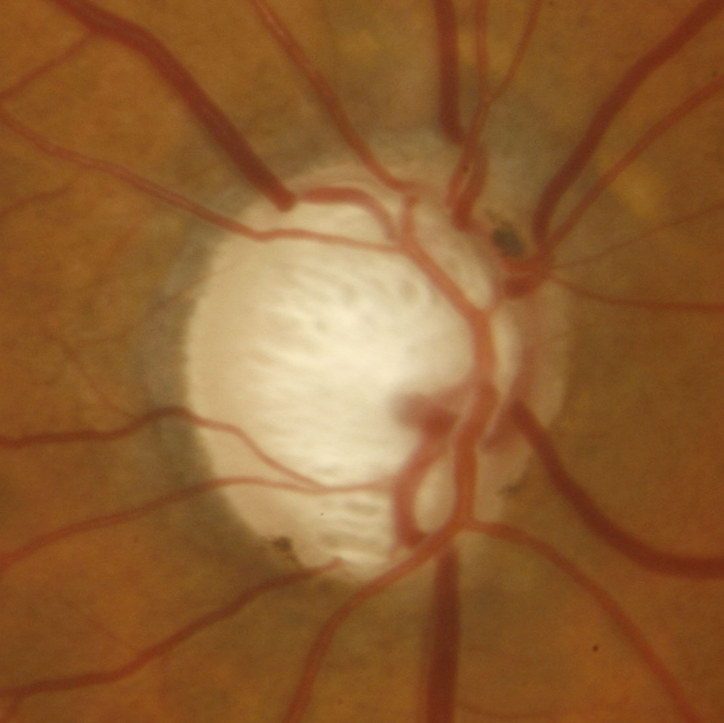 Figure 3.1.5 Glaucomatous Optic Disc