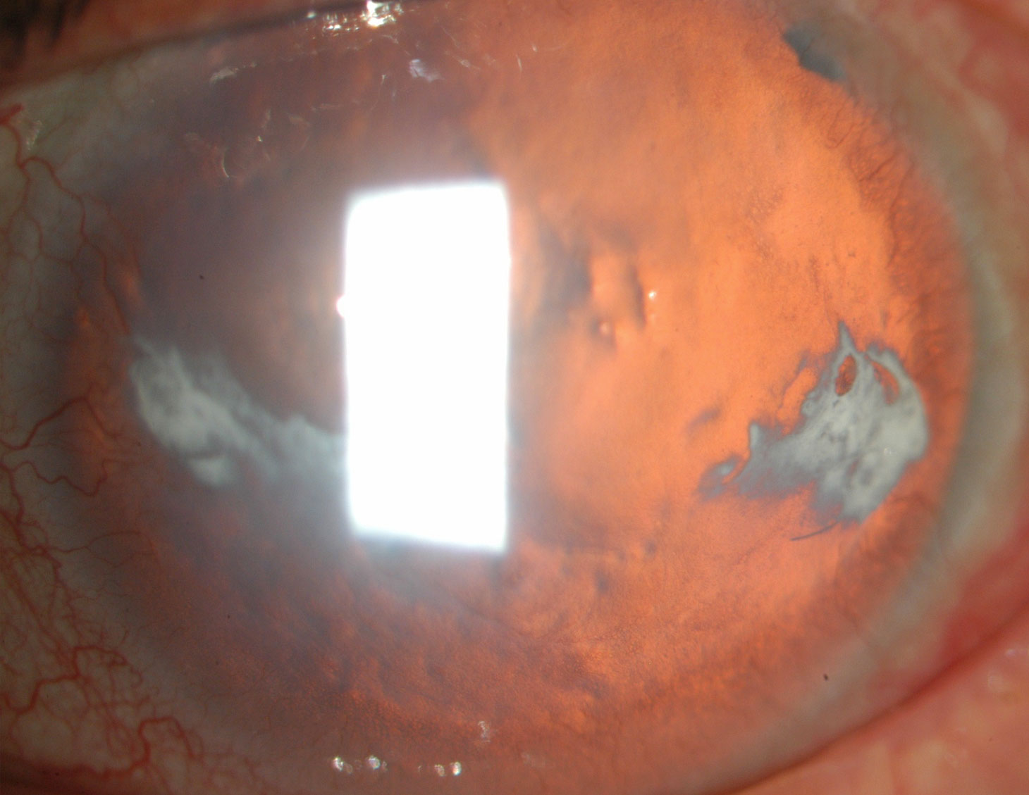 Figure 3.2.4 Childhood Glaucoma: Aniridia