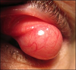 Figure 5.4.3 Upper Lid Ptosis Secondary to a Lipoma