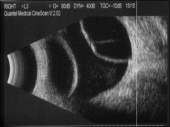 Figure 9.10.7 B-scan of Choroidal Effusion