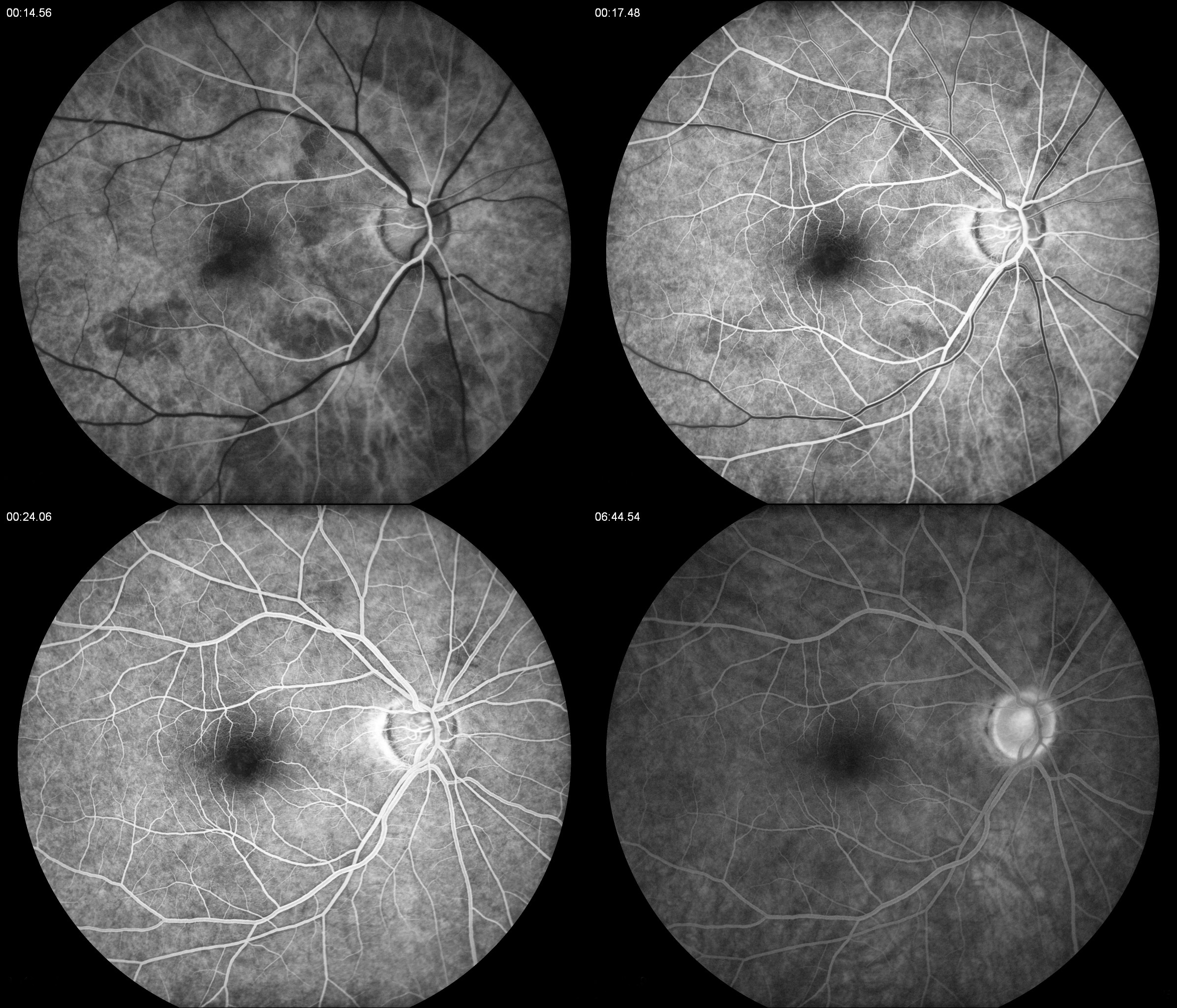 Figure 9.8.1 Phases of a Normal Fundus Fluorescein Angiogram