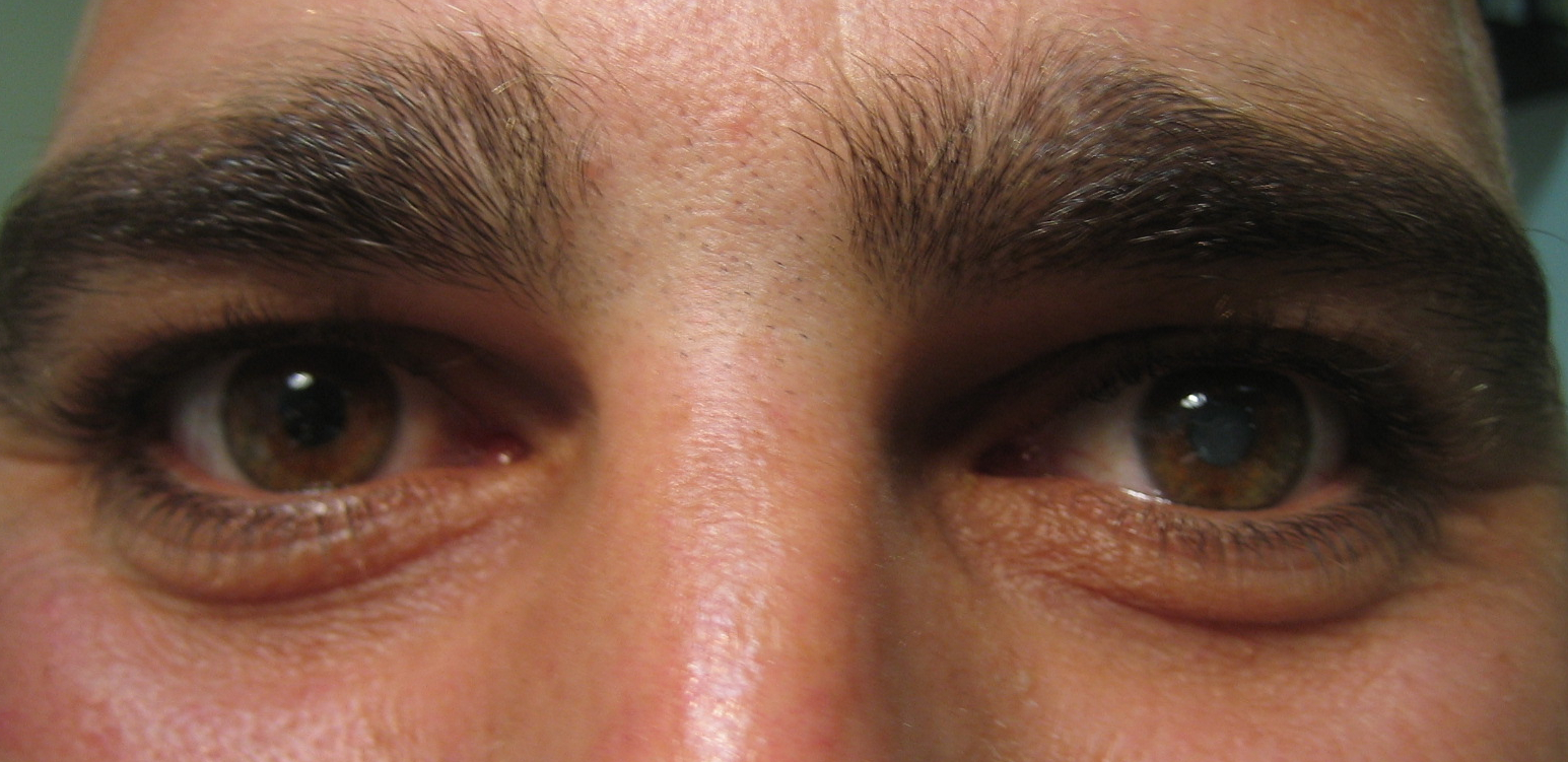 Figure 1.2.1  Left Unilateral Cataract
