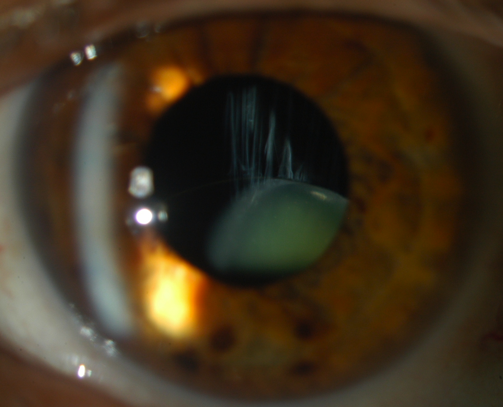 Figure 1.2.10 Ectopia Lentis Secondary to Weill-Marchesani Syndrome