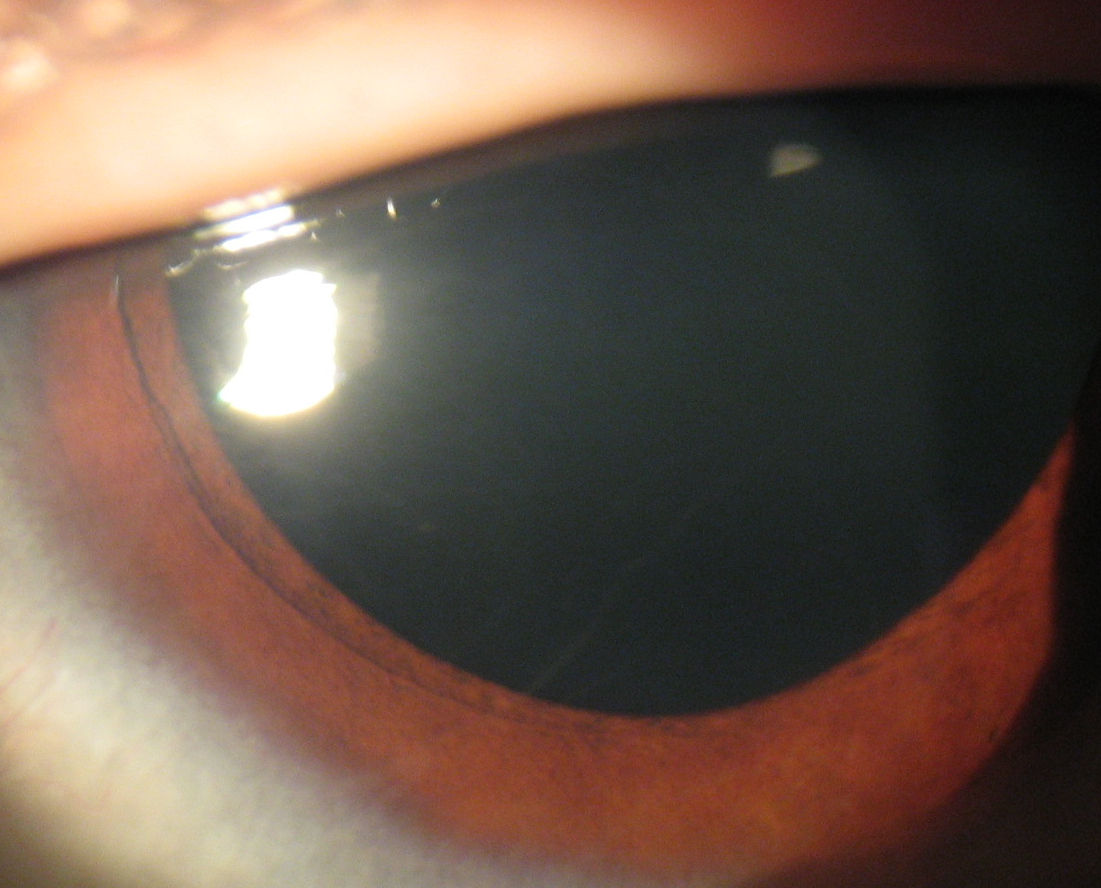 Figure 1.2.11 Enlarged Corneal Nerves