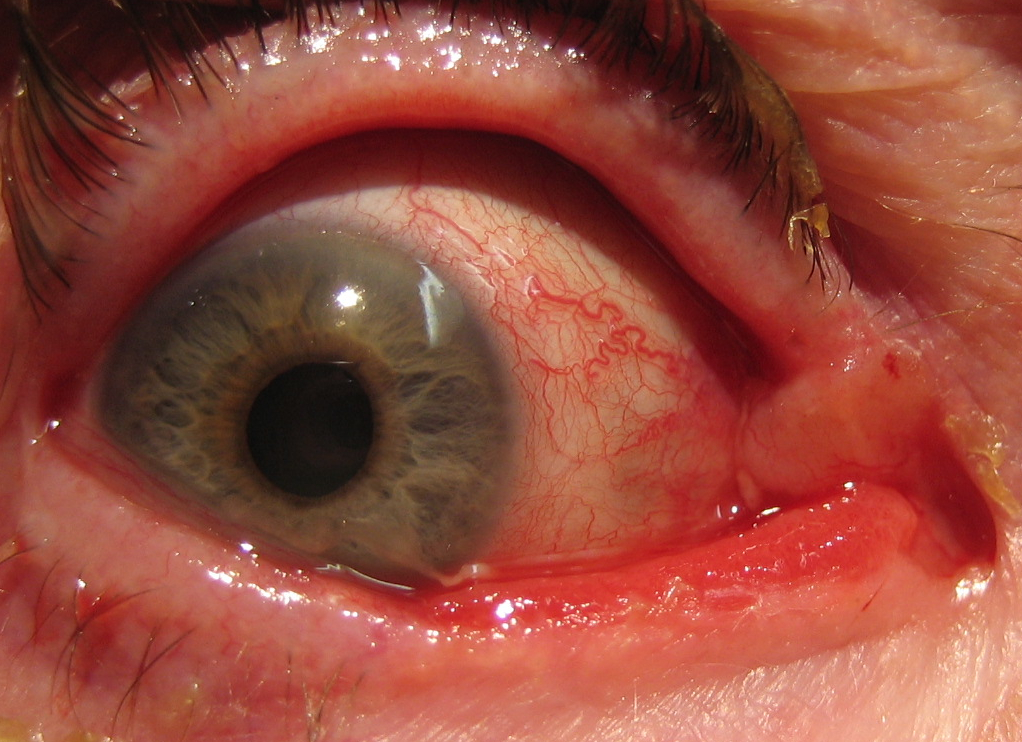 Figure 1.2.14 Medial Canthal Basal Cell Carcinoma