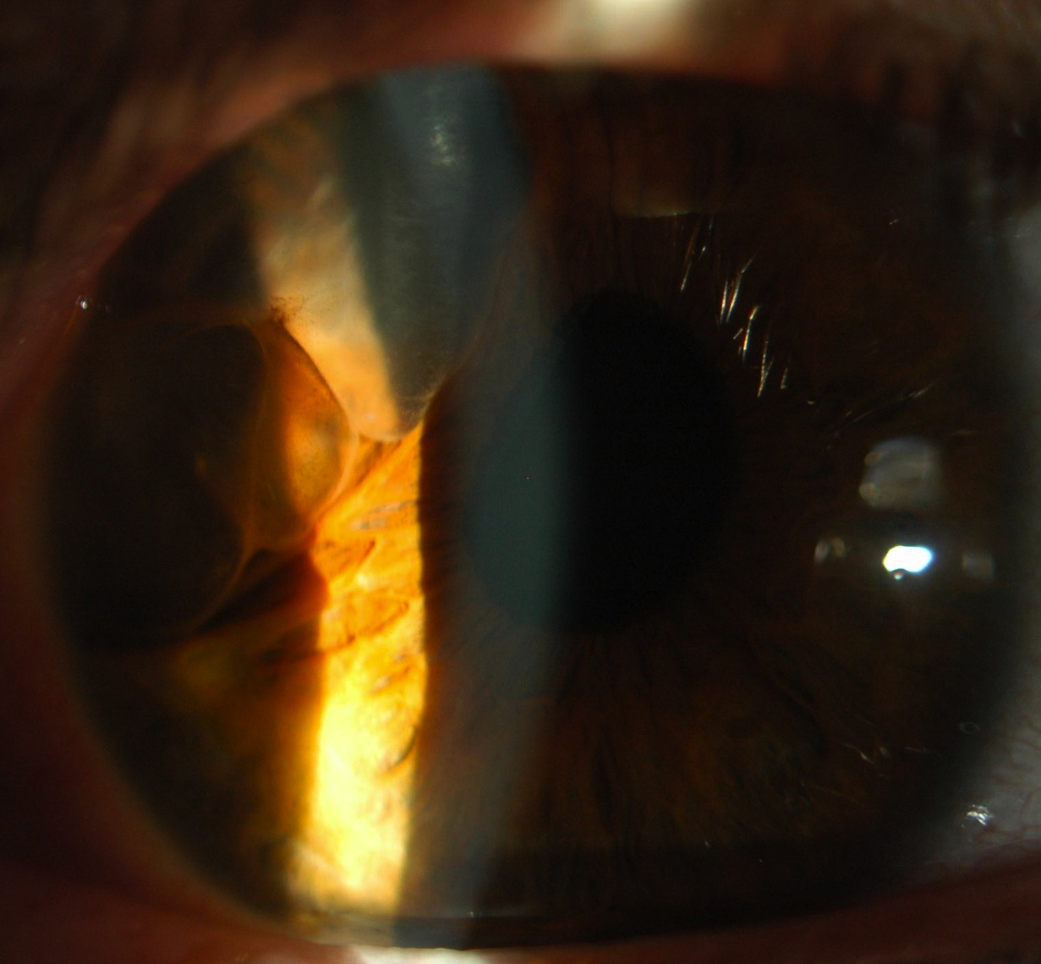 Figure 1.2.19  Iris Cyst