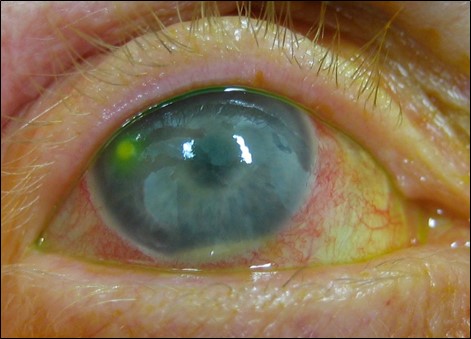 Figure 1.2.20 Corneal Infiltrate with Epithelial Defect and Hypopyon