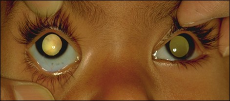 Figure 1.2.21 Leucocoria Secondary to Retinoblastoma