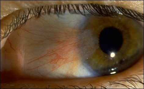 Figure 1.2.22 Pterygium