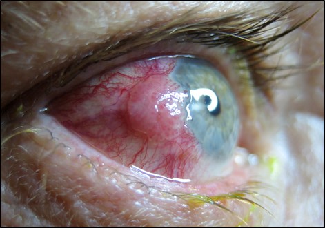 Figure 1.2.4 Conjunctival Squamous Cell Carcinoma
