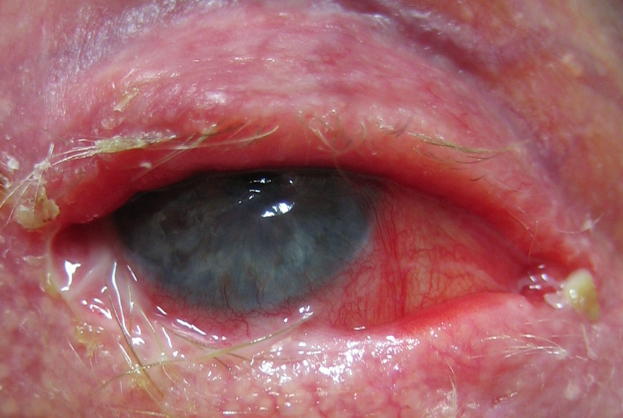 Figure 1.2.6 Cicatrising Conjunctivitis