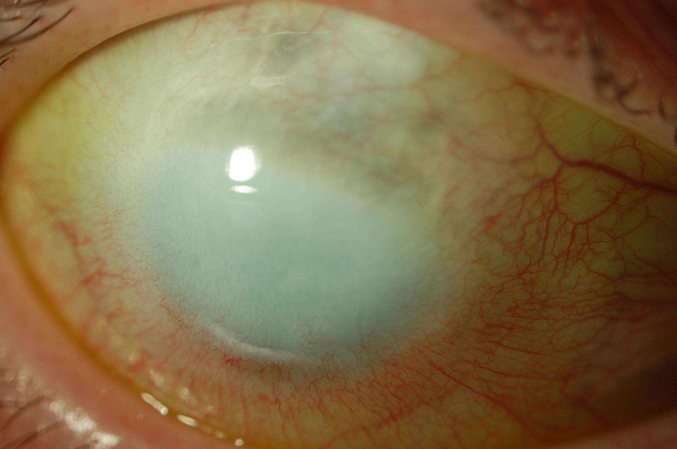 Figure 1.2.7 Sclerocornea