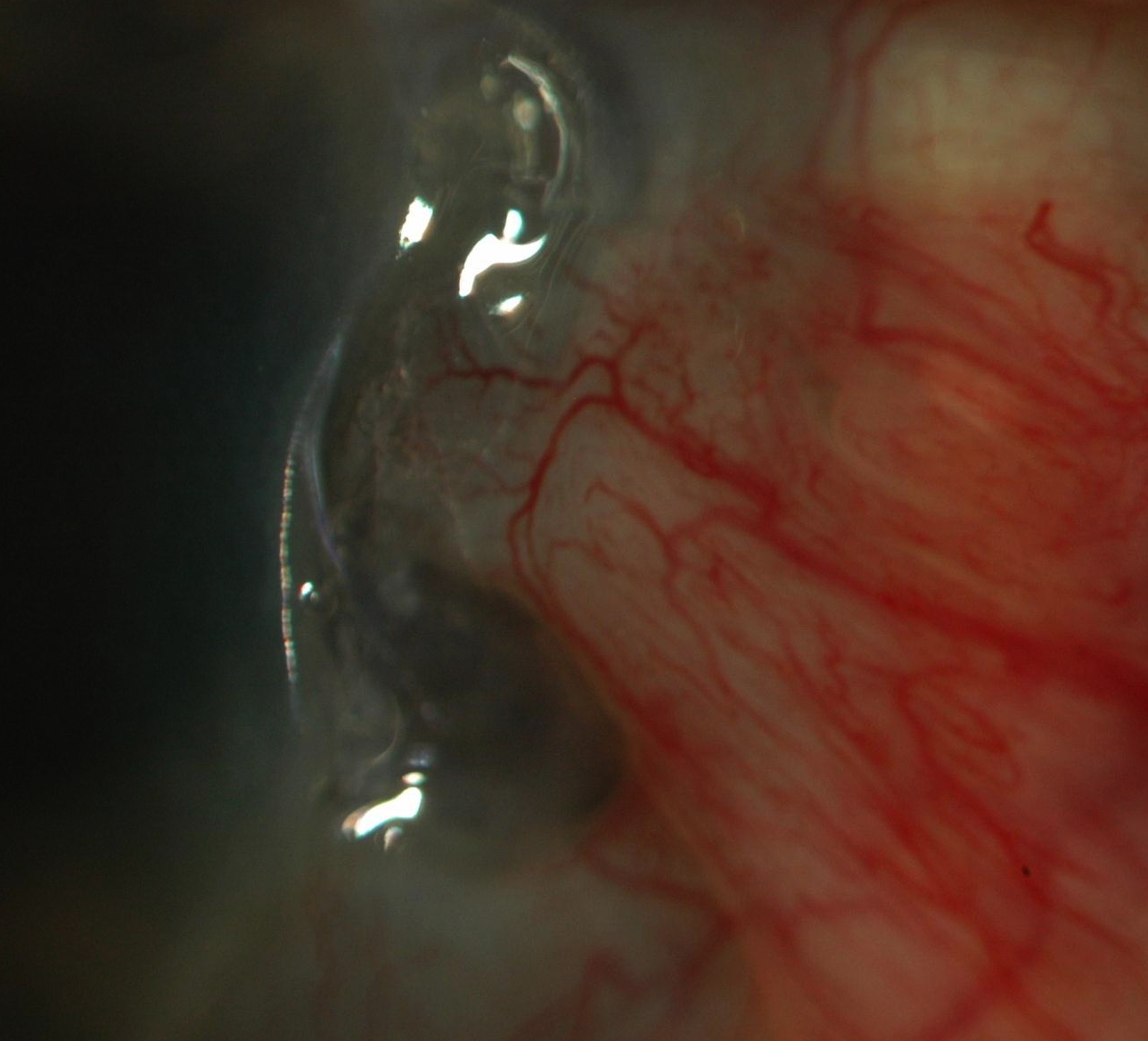 Figure 1.2.9 Peripheral Ulcerative Keratitis Secondary to Prior Beta Radiation