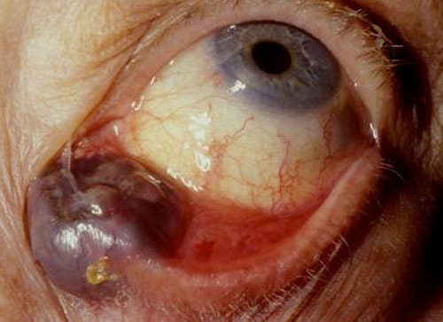 Figure 1.2.15 Melanoma of The Medial Lower Eyelid