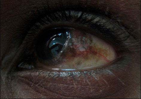 Figure 1.2.5 Conjunctival Epithelial Melanosis