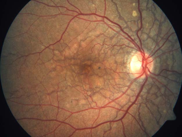 Figure 2.3.1 Angioid Streaks and Peau D’orange in Pseudoxanthoma Elasticum