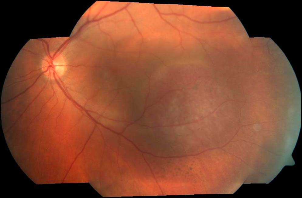 Figure 2.3.10 Choroidal Hemangioma