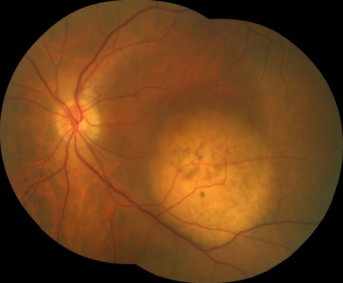 Figure 2.3.11 Choroidal Metastasis