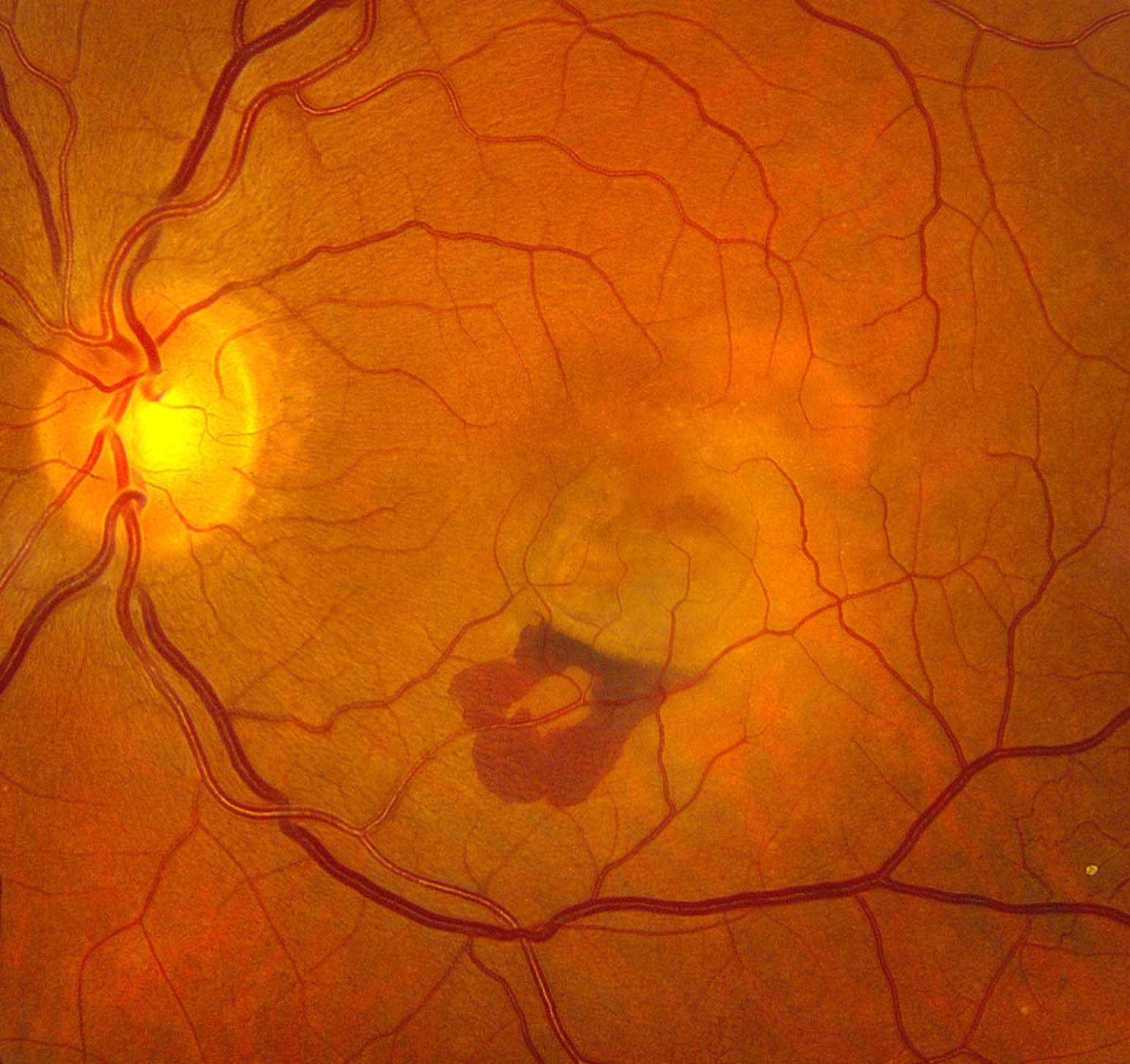 Figure 2.3.12 Choroidal Neovascularization 