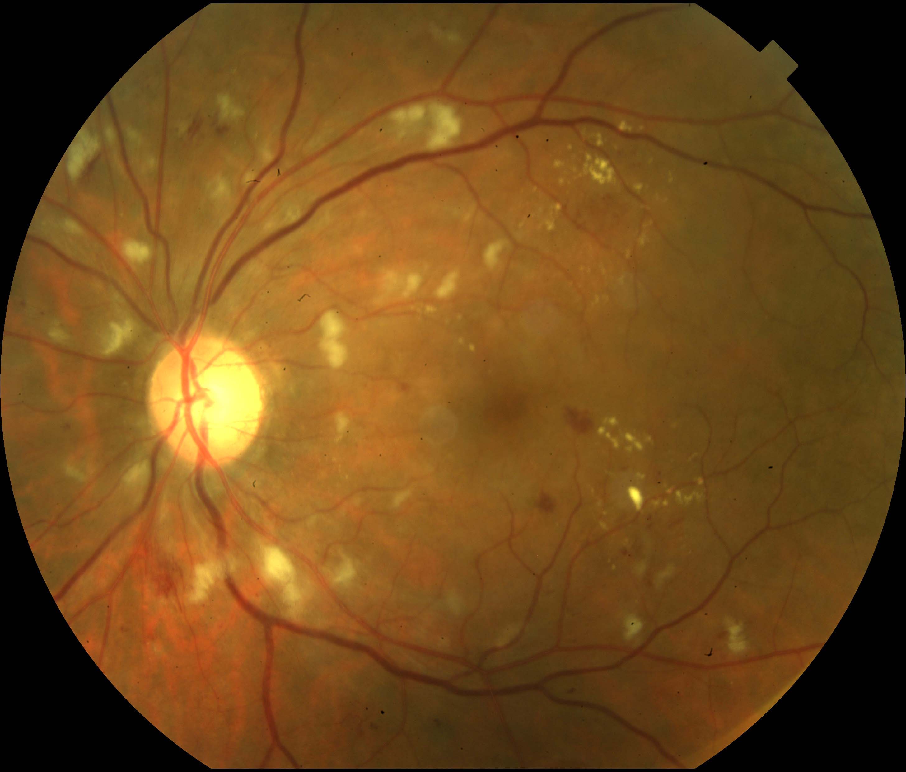 Figure 2.3.13 Cotton Wool Spots in Purtscher’s Retinopathy