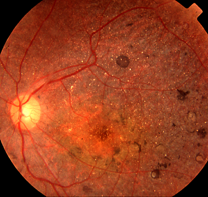 Figure 2.3.14 Crystalline Retinopathy (Bietti Crystalline Dystrophy)