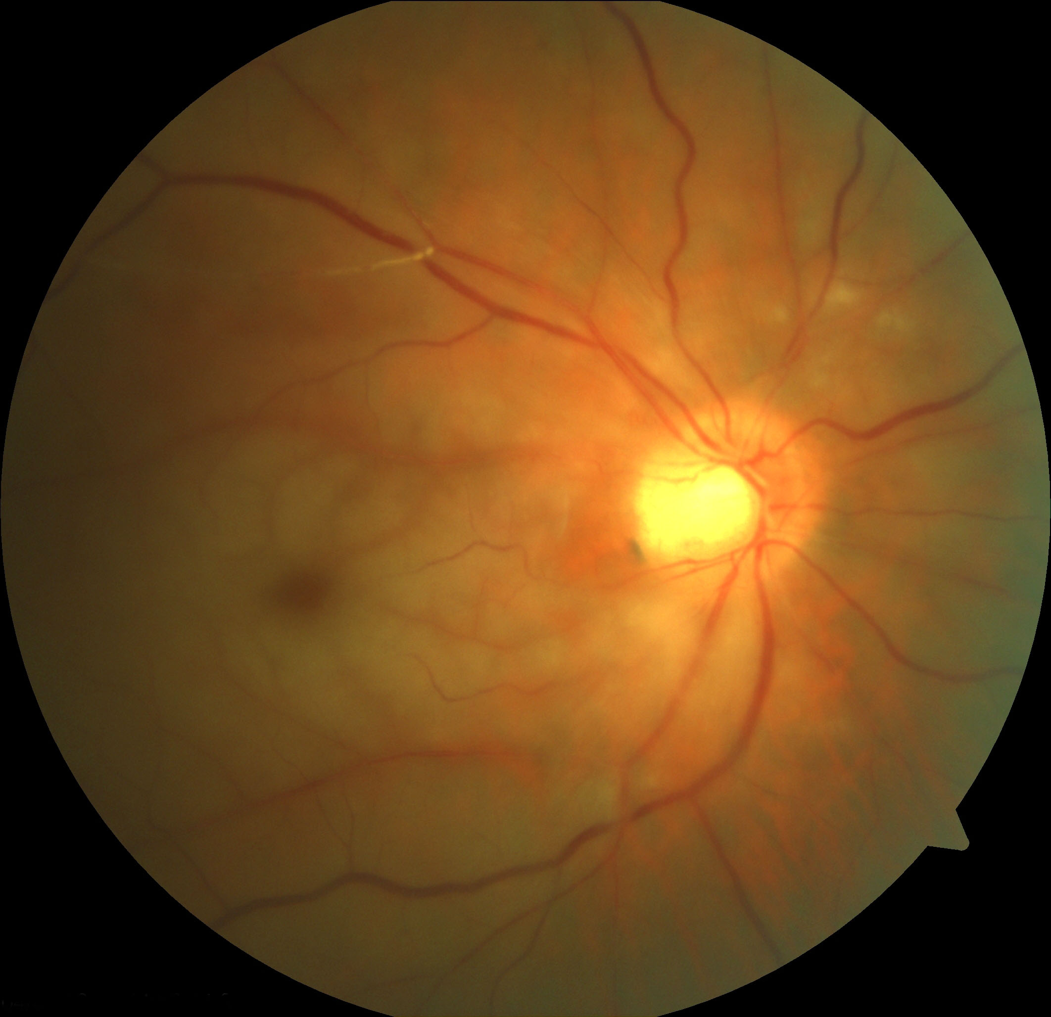 Figure 2.3.15 Cherry Red Spot