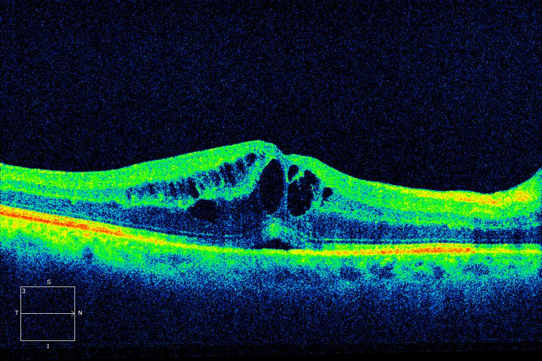 Figure 2.3.16 Cystoid Macular Oedema