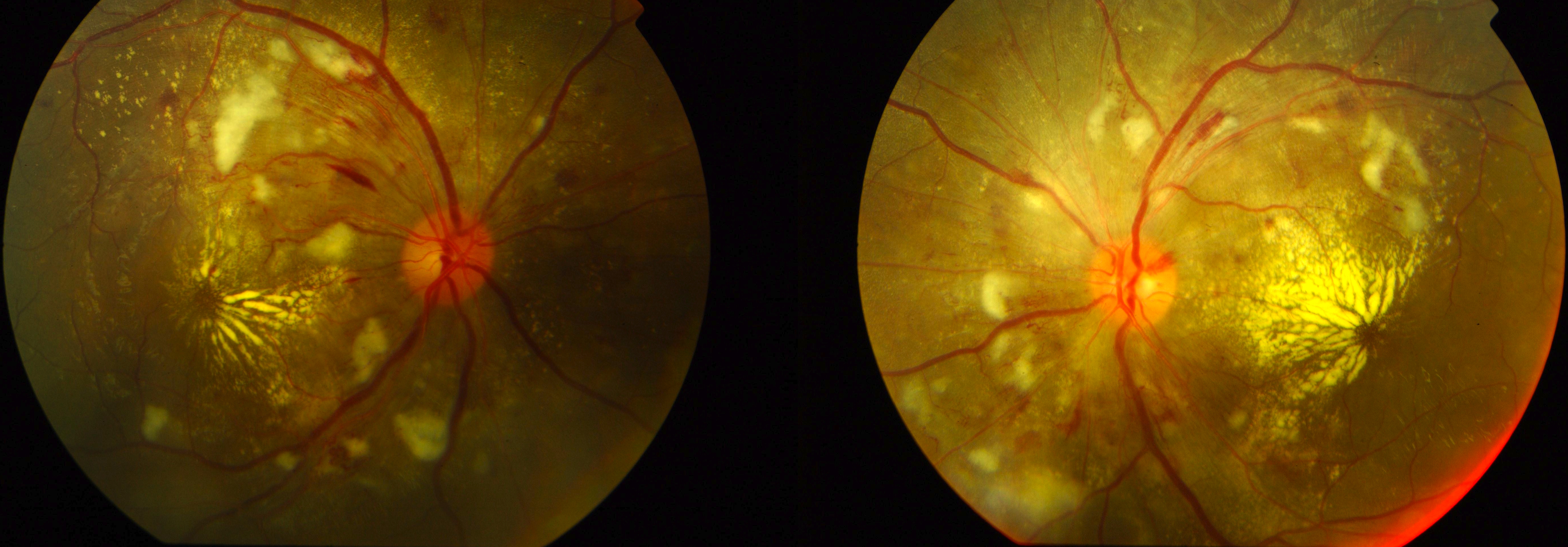 Figure 2.3.17 Malignant Hypertensive Retinopathy