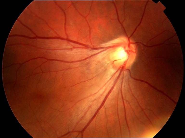 Figure 2.3.18 Dragged Optic Disc