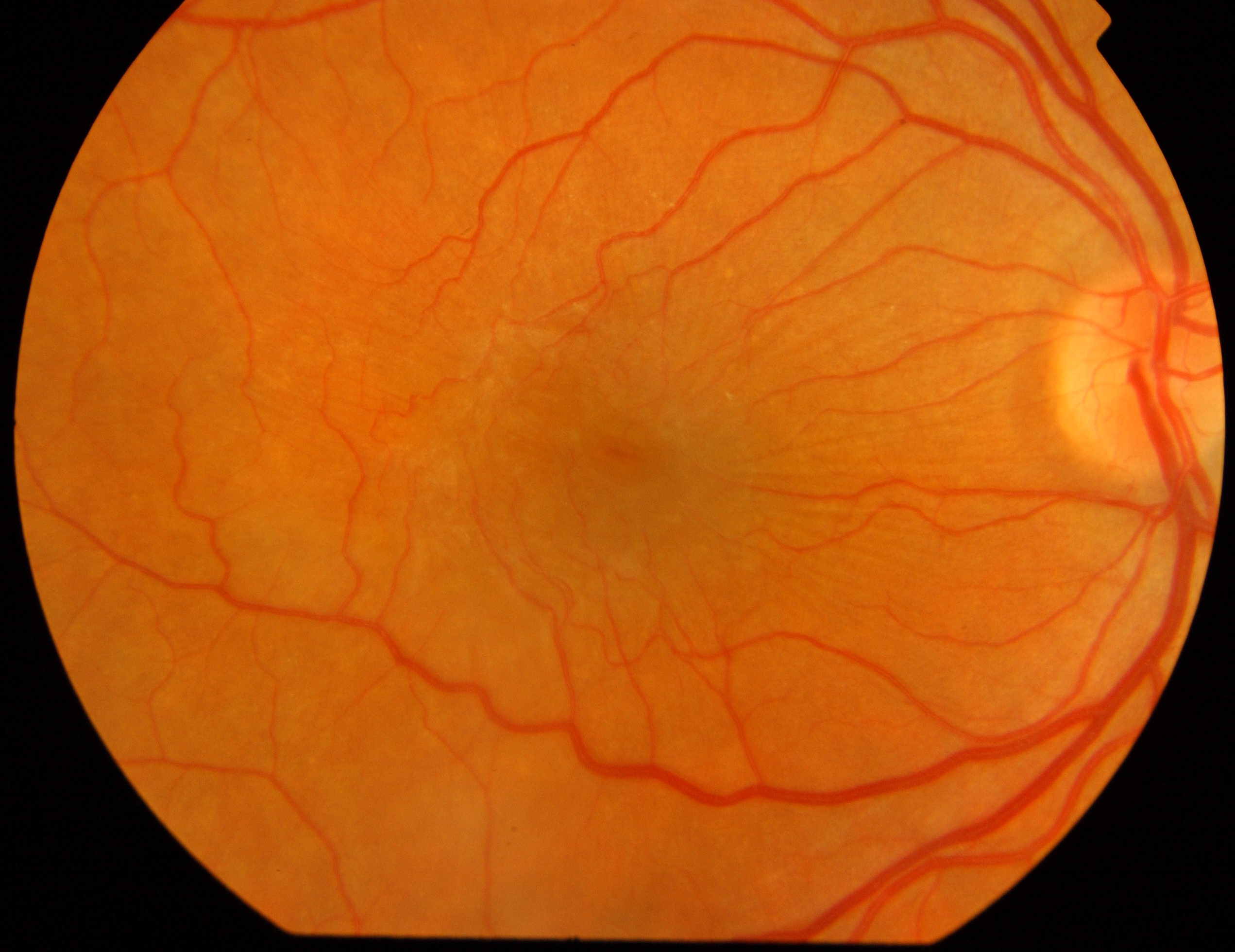 Figure 2.3.19 Epiretinal Membrane