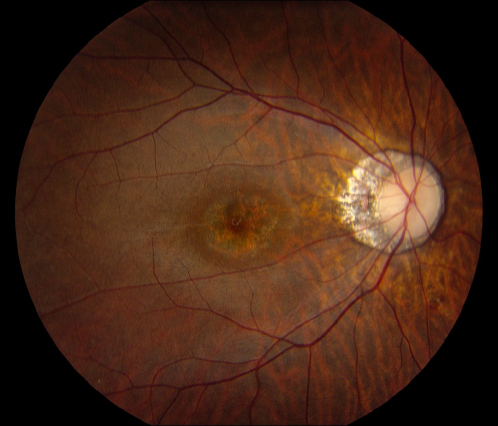 Figure 2.3.2 Bull’s Eye Maculopathy (Cone Dystrophy)