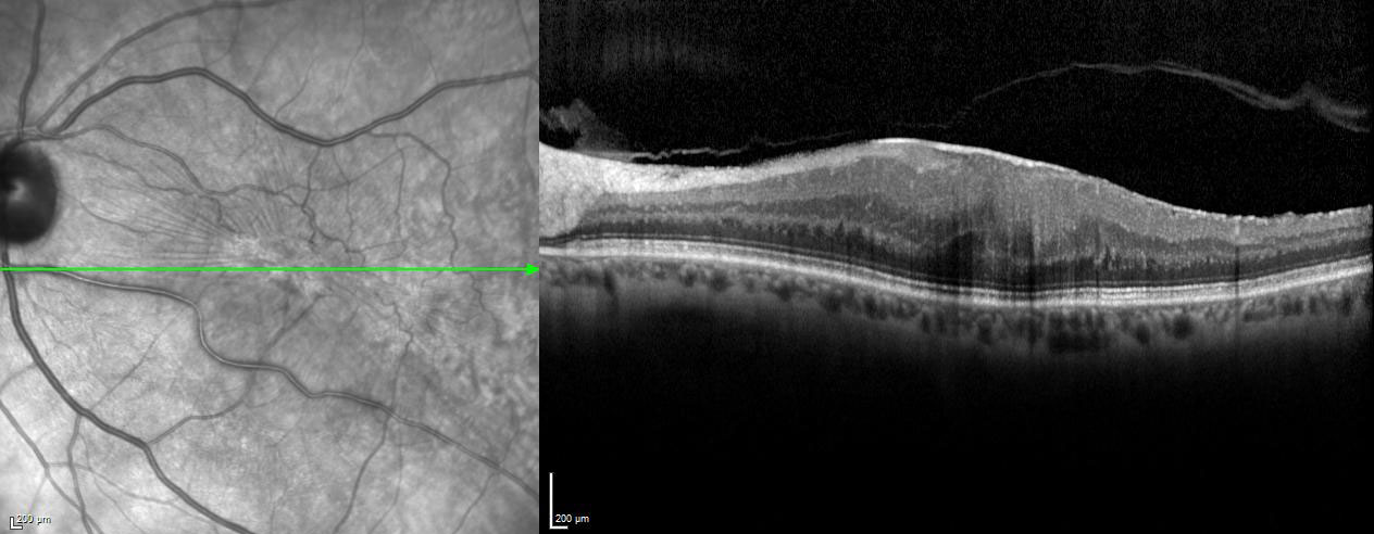 Figure 2.3.20 Epiretinal Membrane on Optical Coherence Tomography