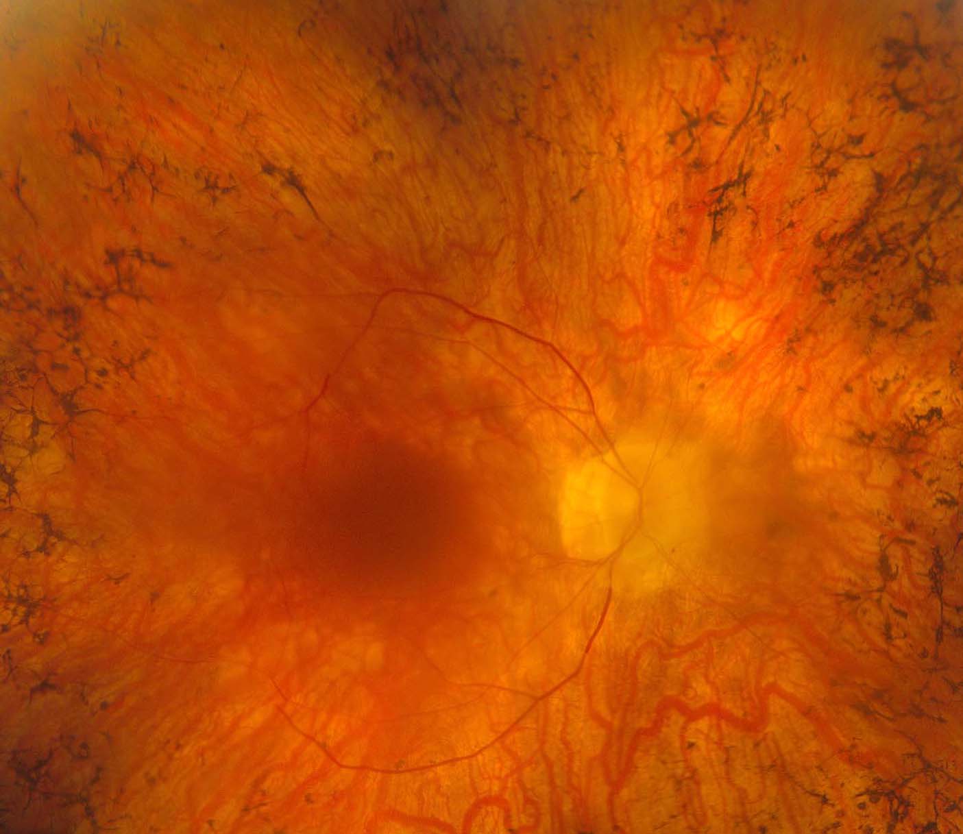 Figure 2.3.21 Pigmentary Retinopathy in Retinitis Pigmentosa
