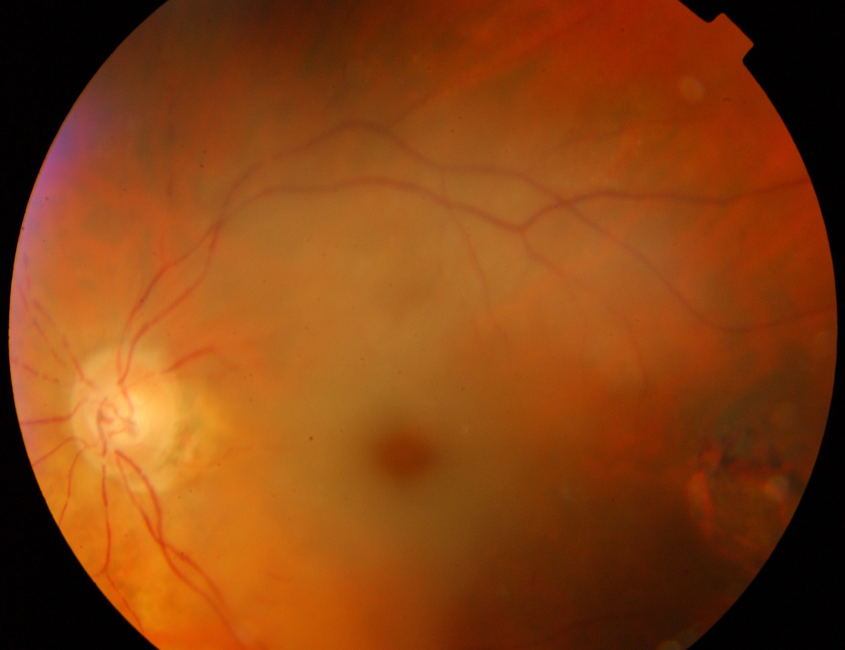 Figure 2.3.22 Central Retinal Artery Occlusion
