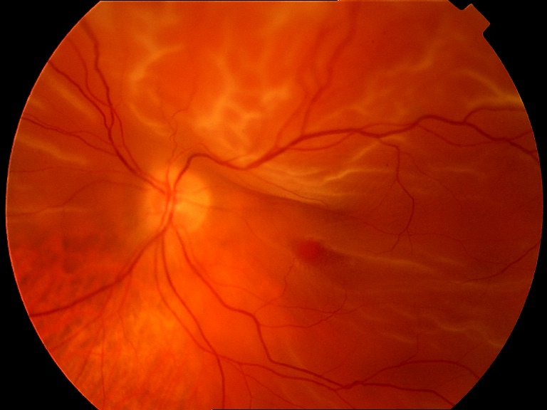 Figure 2.3.24
Bullous Macula-Off Rhegmatogenous Retinal Detachment