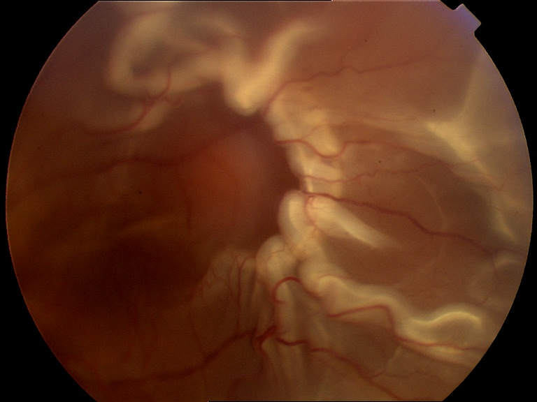 Figure 2.3.25 Rhegmatogenous Retinal Detachment with Proliferative Vitreoretinopathy and Subretinal Membrane