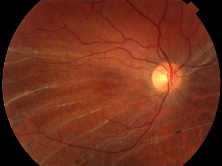 Figure 2.3.26 High-Water Marks from Previous Retinal Detachment
