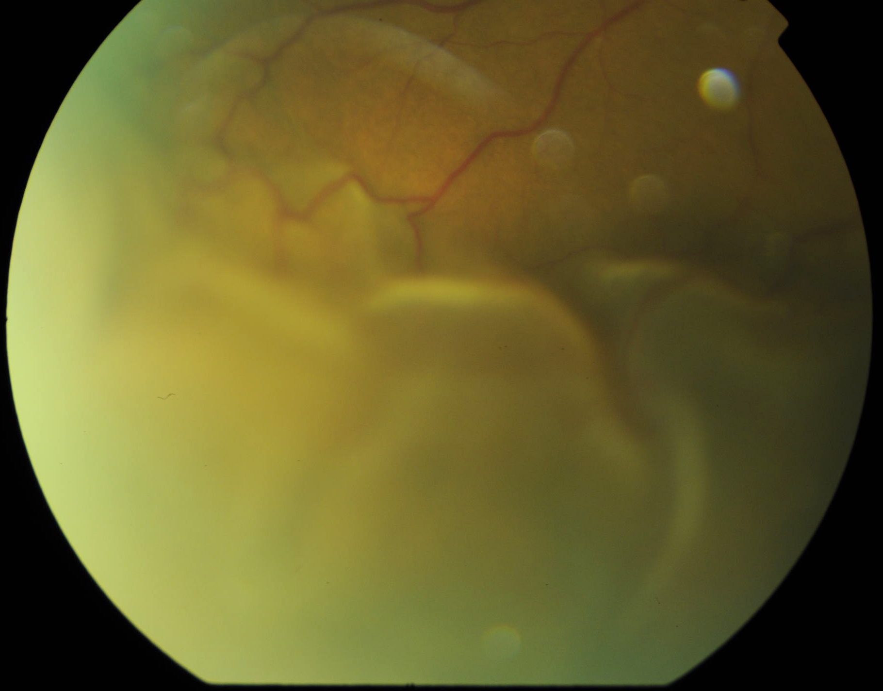 Figure 2.3.28 Uveal Effusion Syndrome