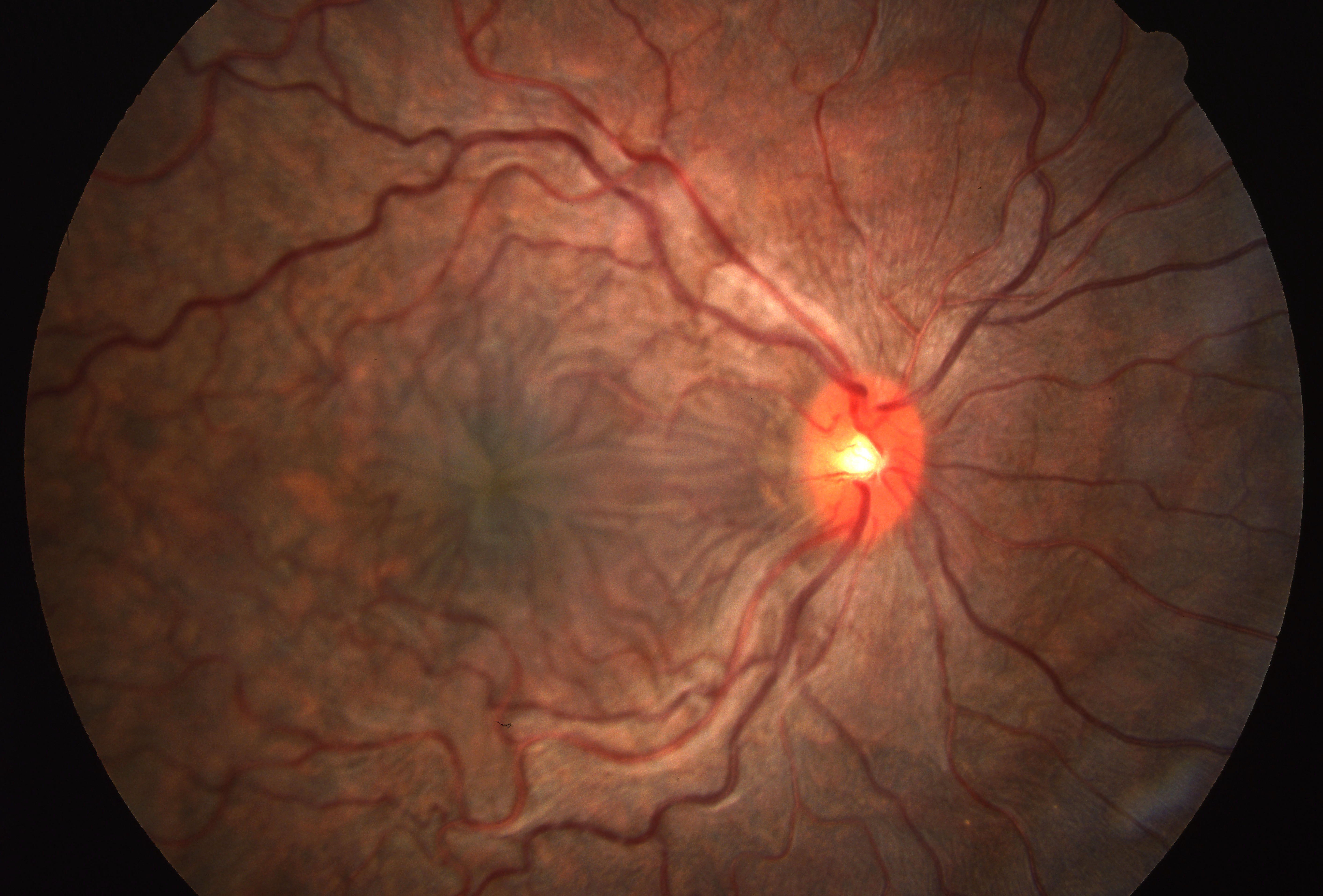 Figure 2.3.3 Gross Choroidal Folds from Orbital Metastasis