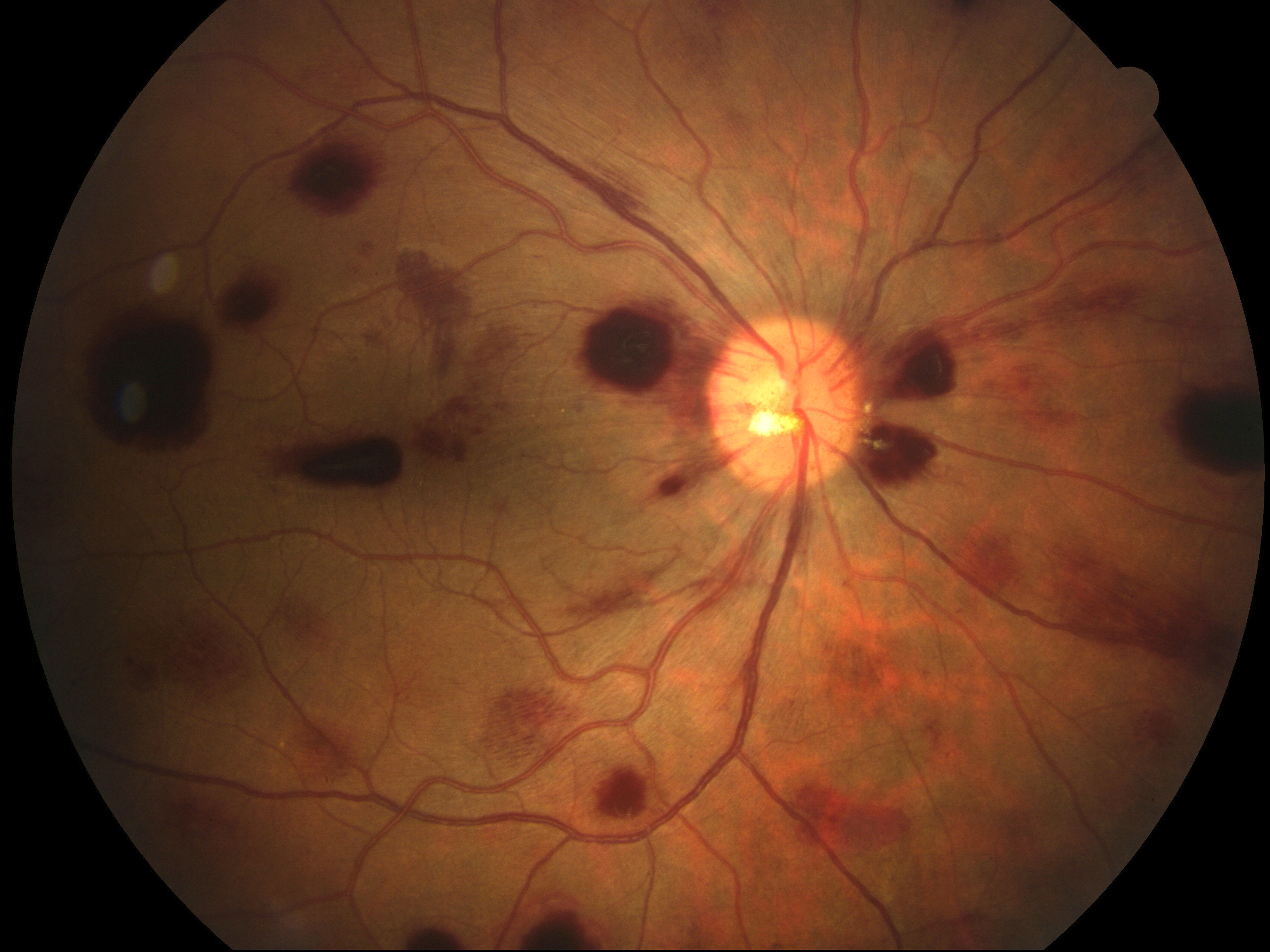 Figure 2.3.34 Retinal Haemorrhages in Patient with Hodgkin’s Lymphoma