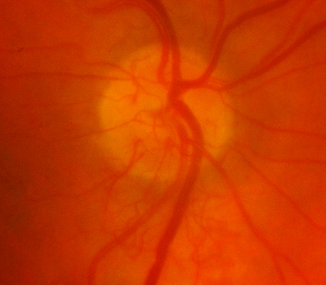 Figure 2.3.36 Neovascularization of the Disc in Diabetic Retinopathy