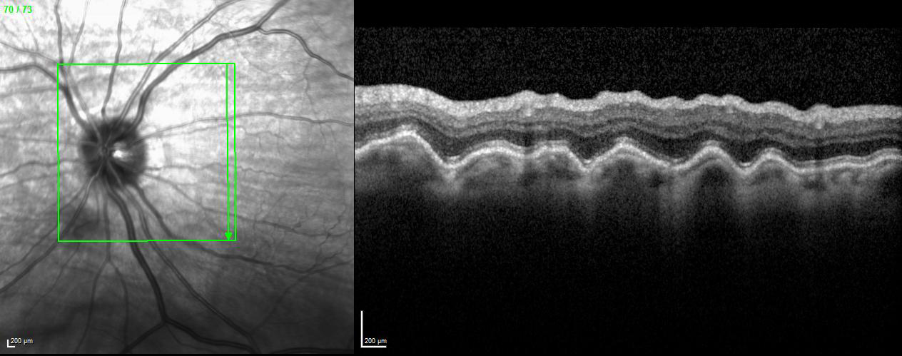 Figure 2.3.4 Choroidal Folds on OCT Scan