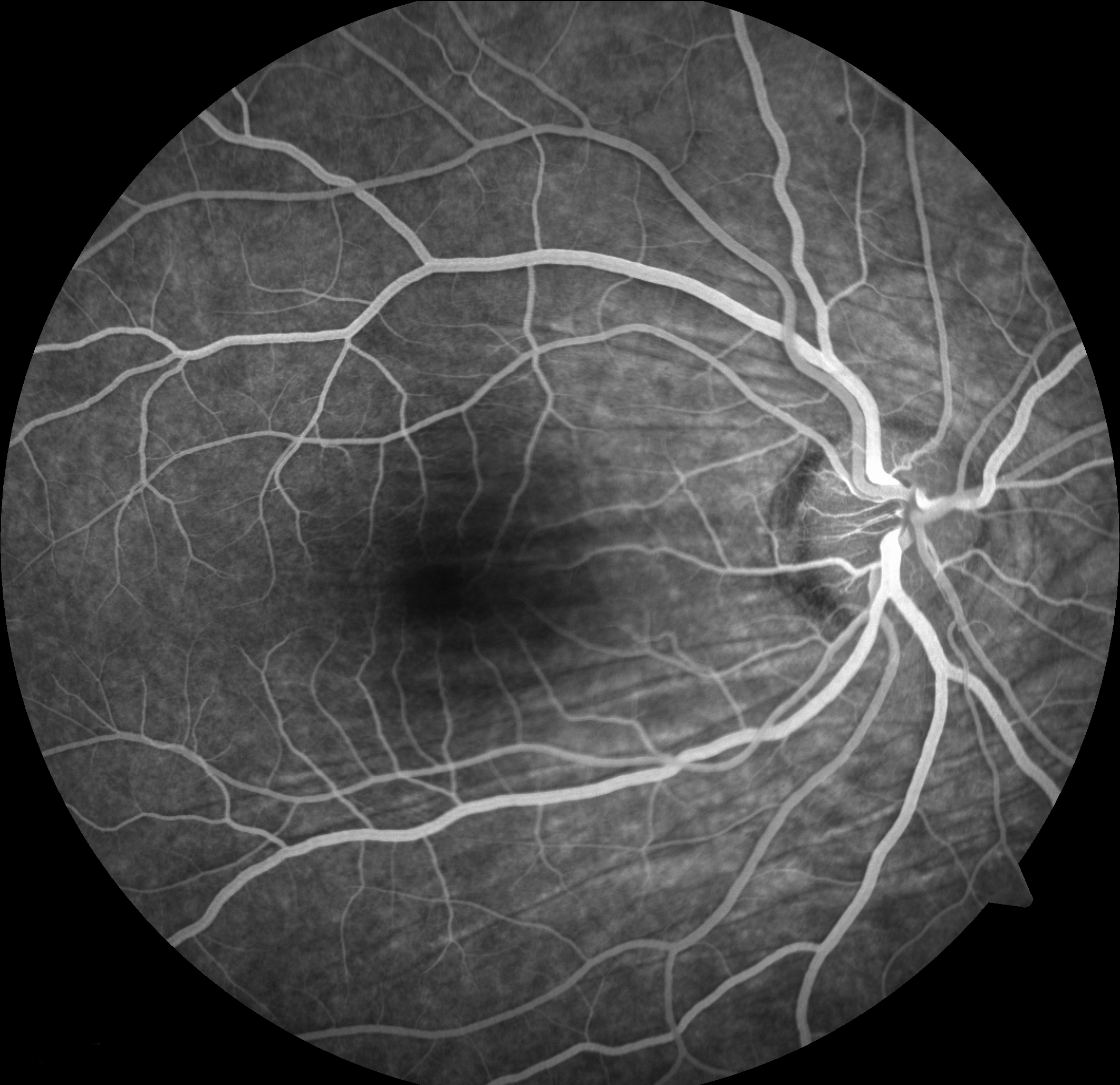 Figure 2.3.6 Choroidal Folds Visible on Fluorescein Angiography