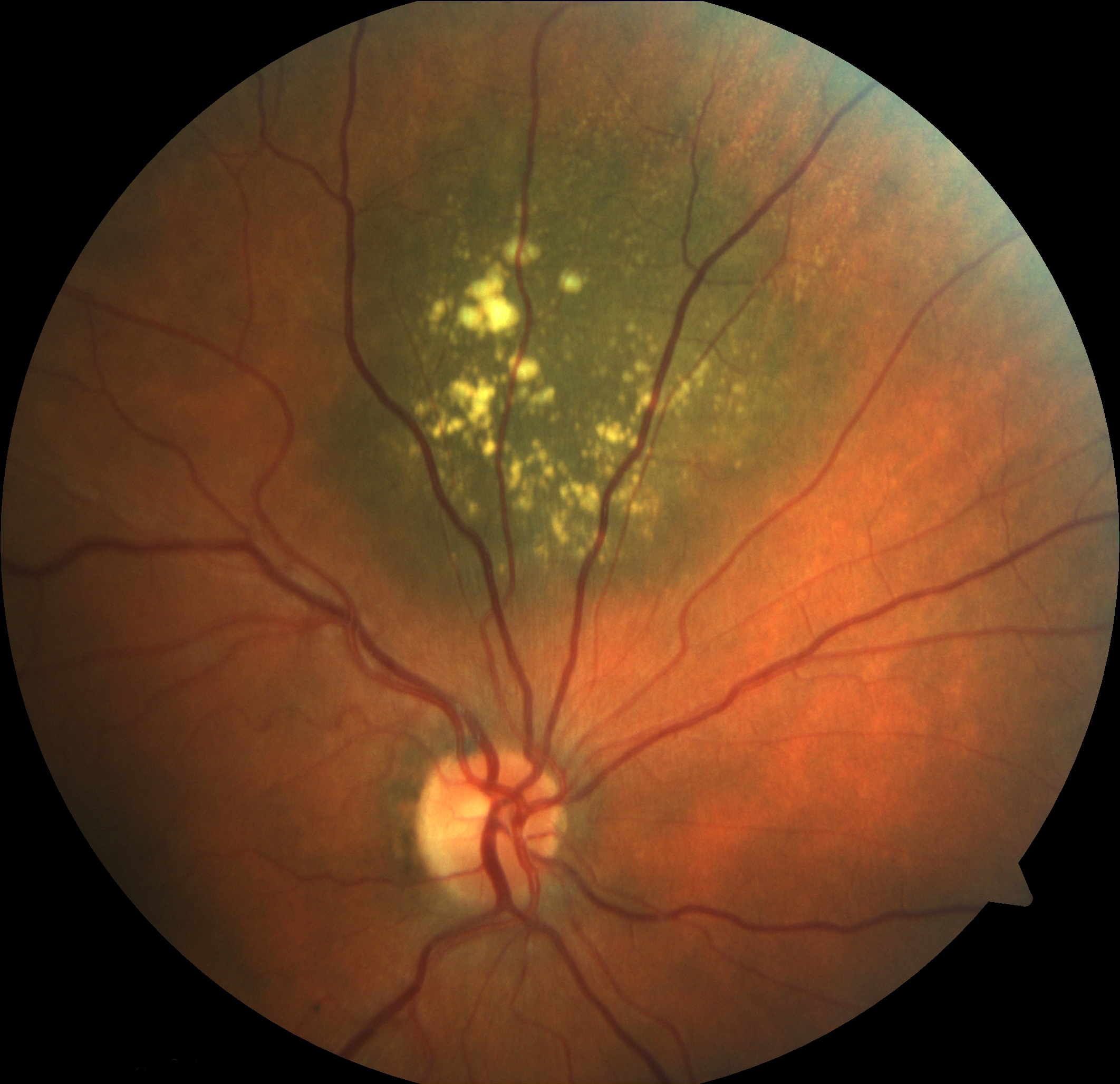 Figure 2.3.7
Choroidal Naevus with Drusen