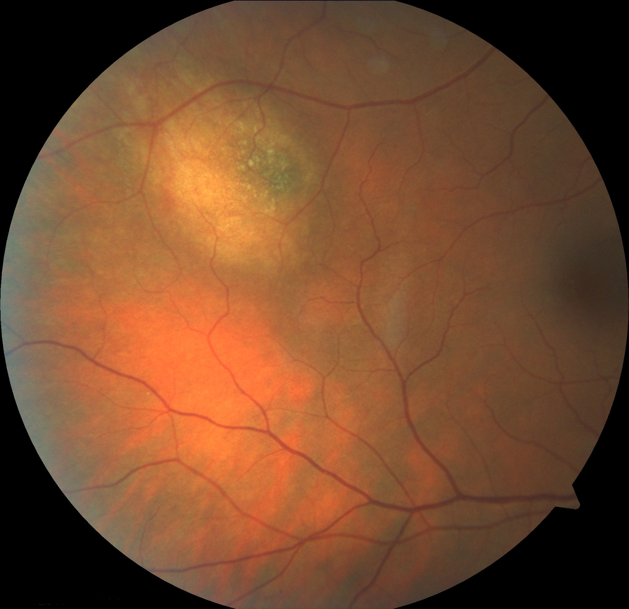 Figure 2.3.8
Amelanotic Choroidal Naevus