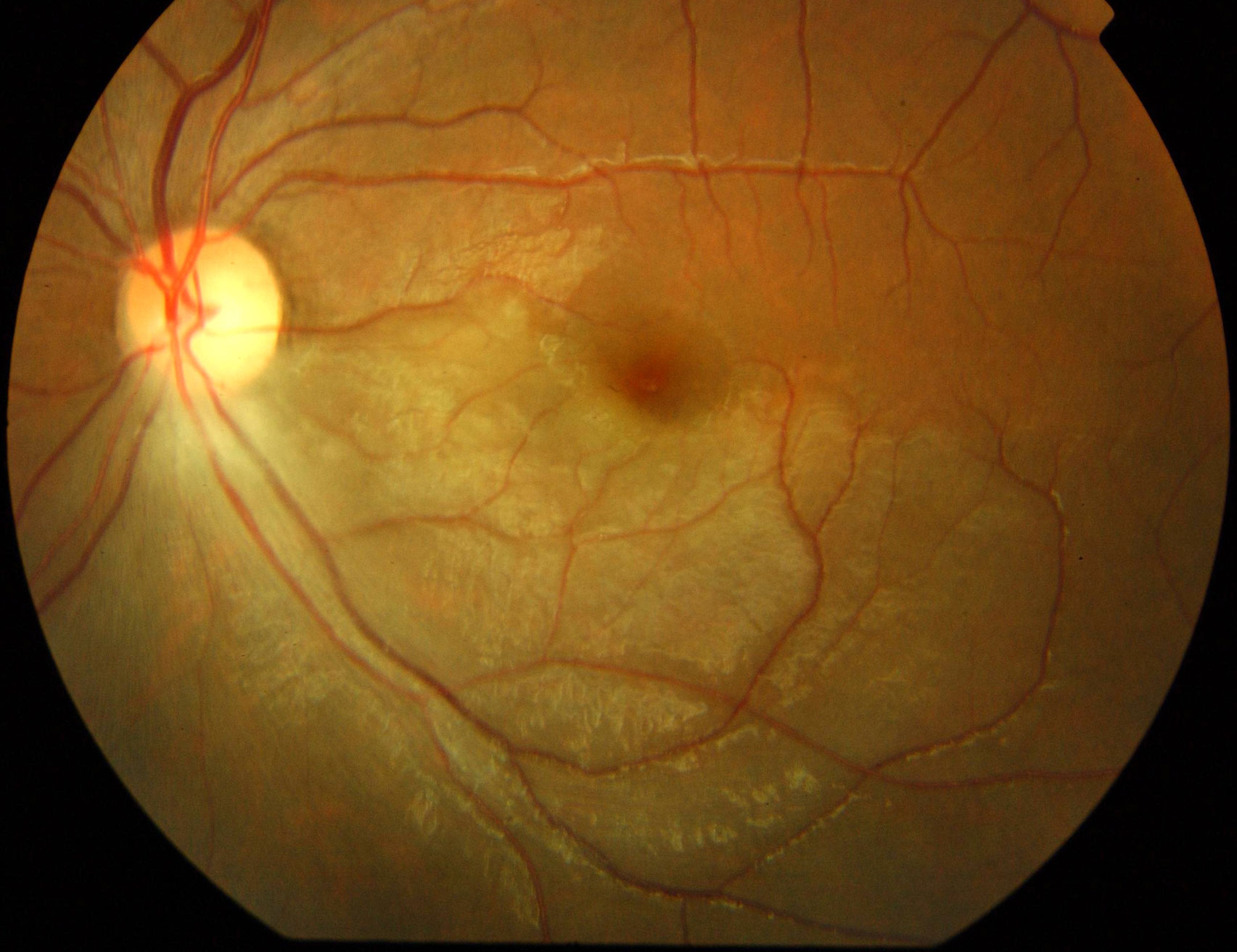 Figure 2.3.23 Branch Retinal Artery Occlusion