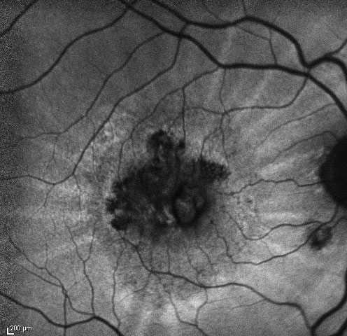 Figure 2.3.5
Choroidal Folds Around an AMD CNV on Fundus Autofluorescence