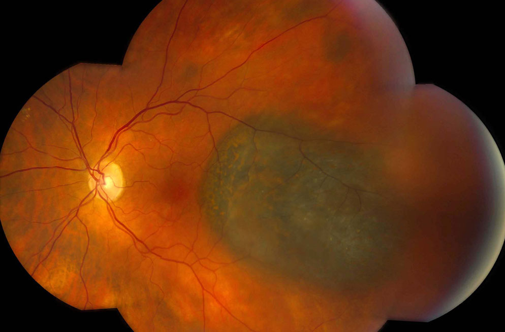 Figure 2.3.9
Choroidal Melanoma