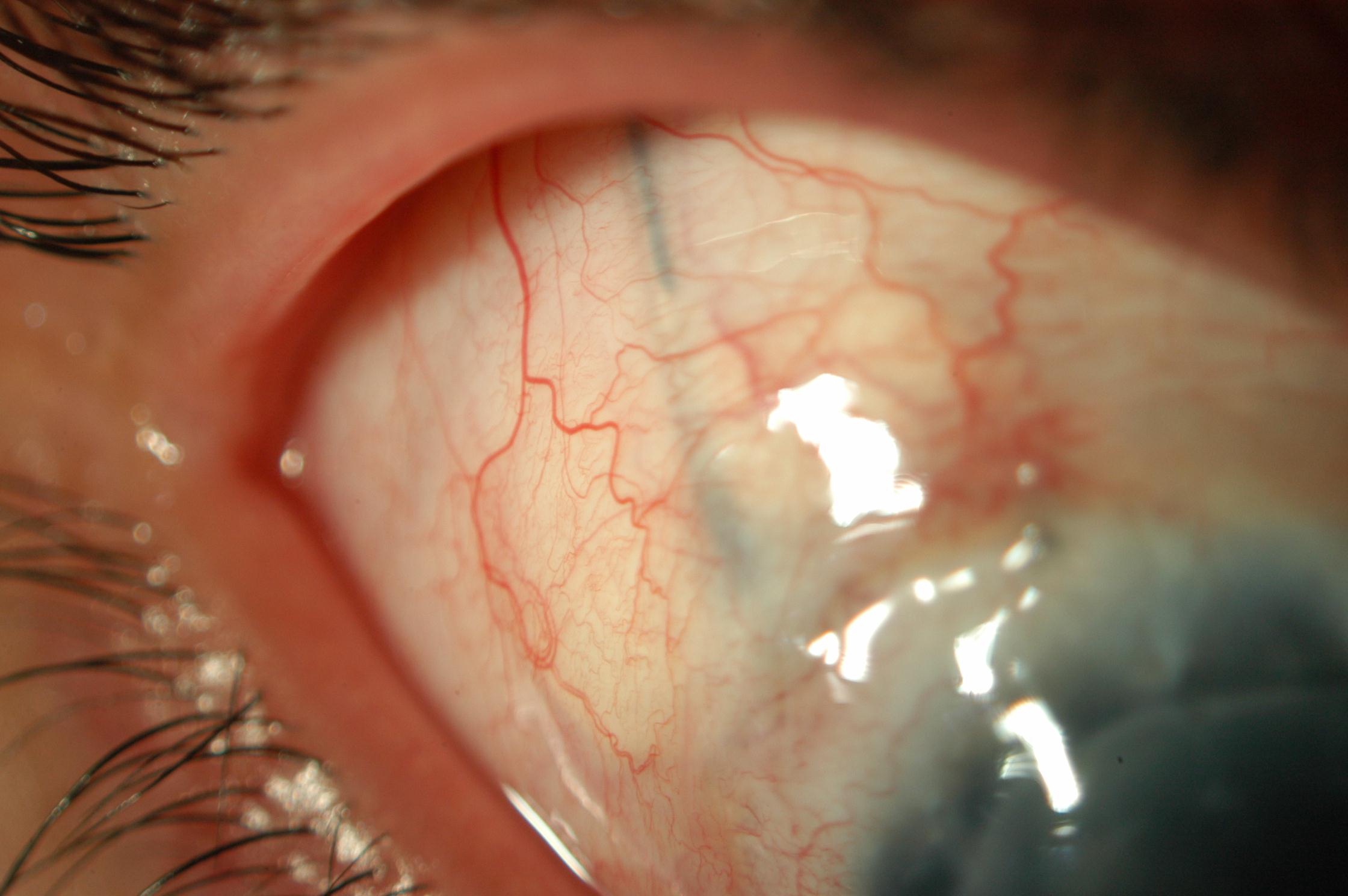 Figure 3.1.2 The Appearance of a Baerveldt Glaucoma Drainage Device on Downgaze